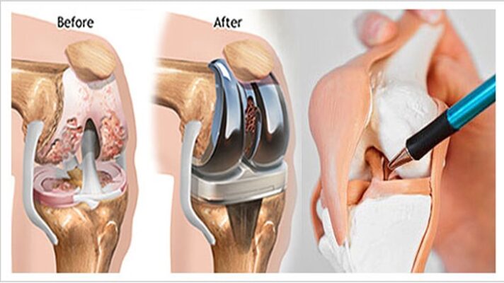 Knee-Replacement